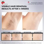 laser hair removal machine with sapphire ice cooling - Image 5